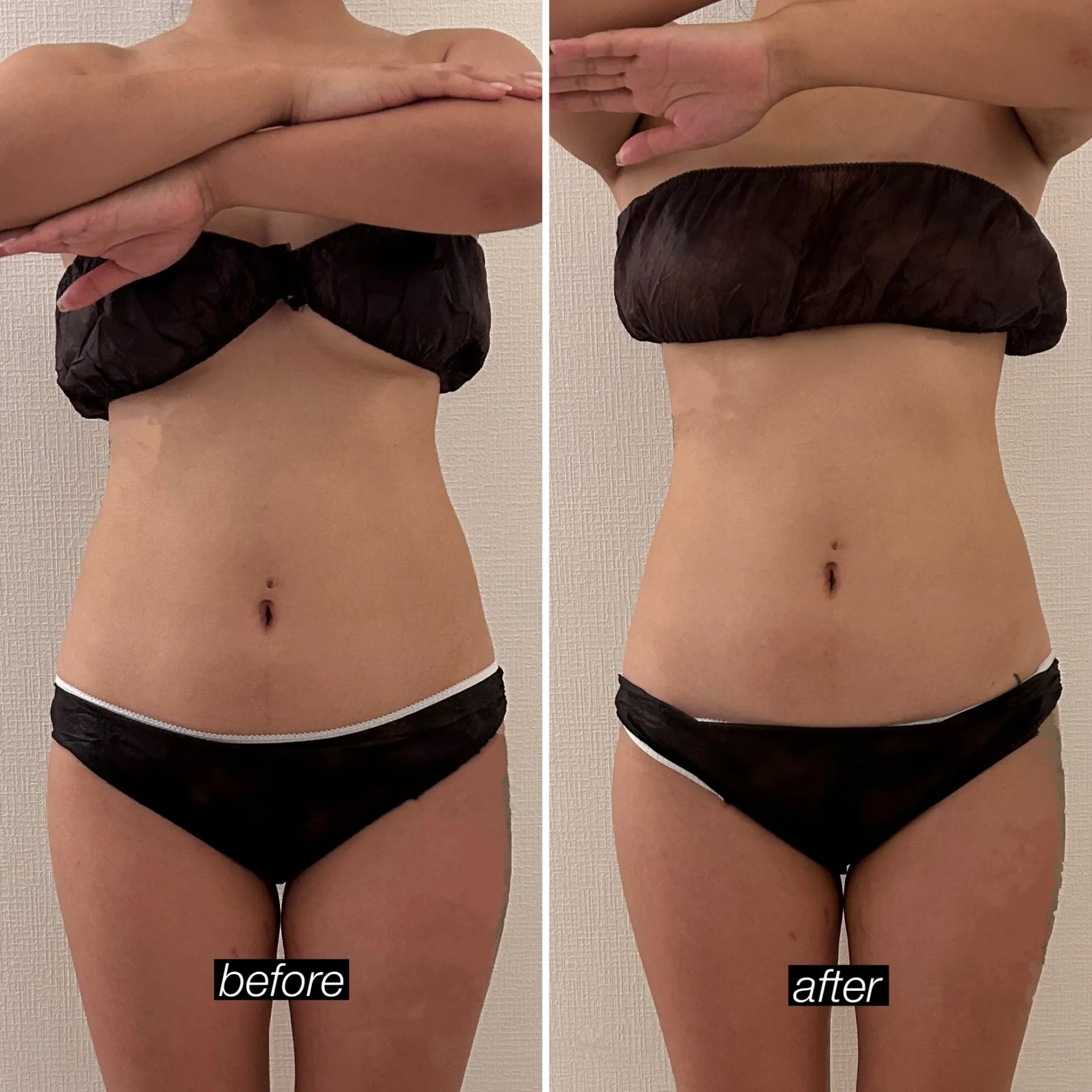 切らない脂肪吸引!セルライト脂肪分解 【キャビゼロ】20分