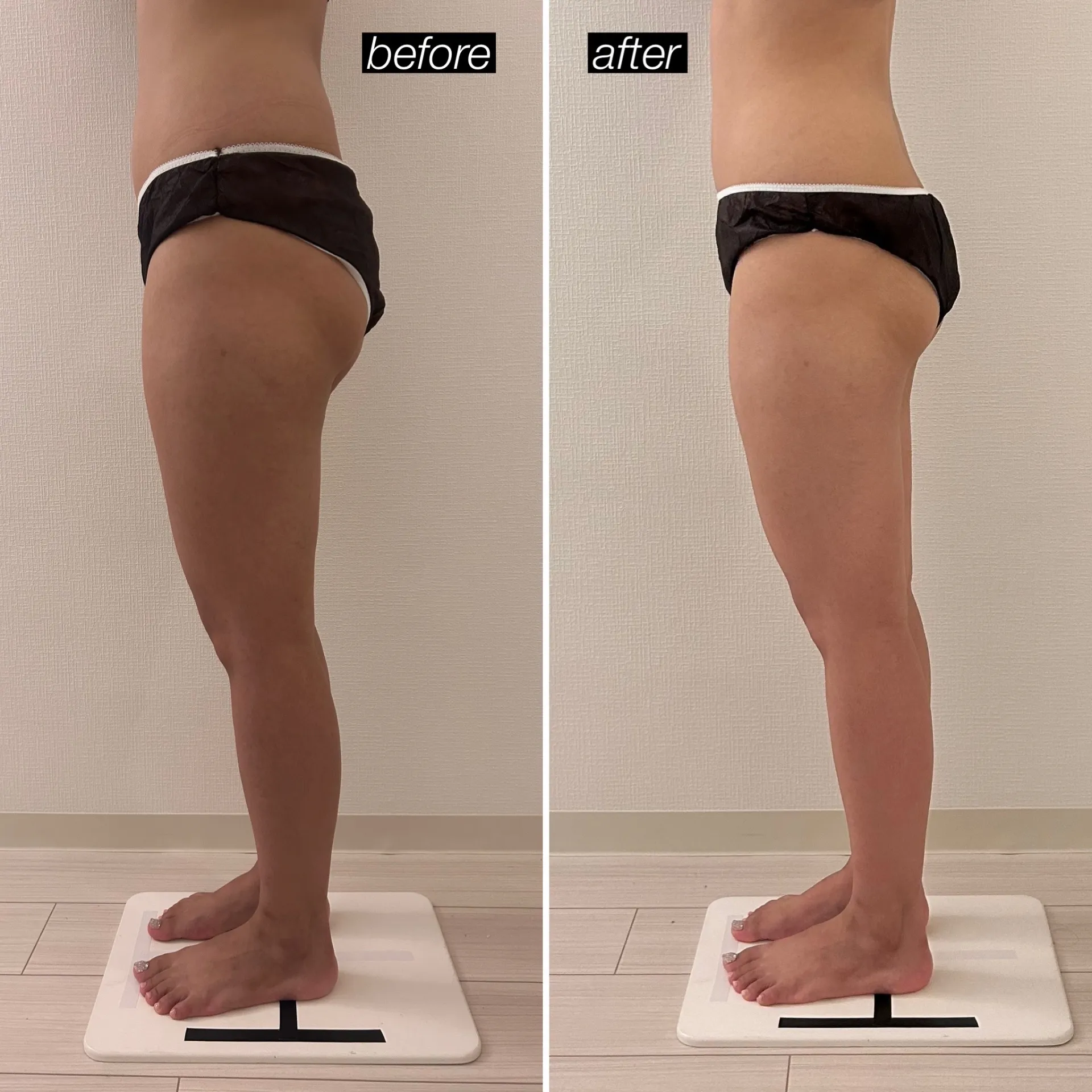 頑固なセルライト脂肪分解で痩身ボディメイク!キャビゼロ80分